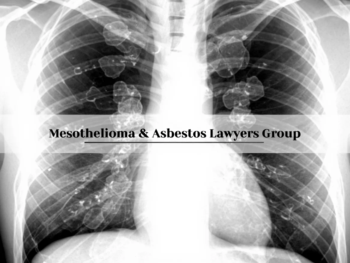 Mesothelioma & Asbestos Lawyers Group of Nebraska