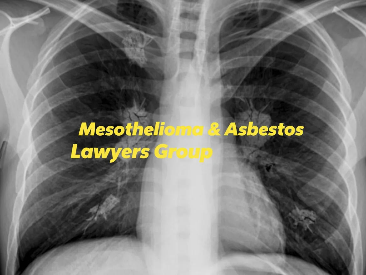 Mesothelioma & Asbestos Lawyers Group of Wisconsin