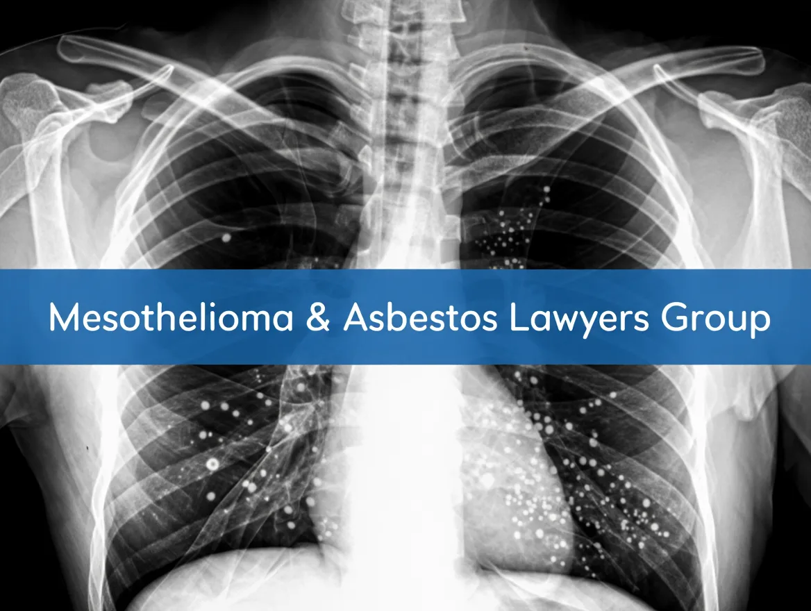 Mesothelioma Asbestos Lawyers Group of Wyoming